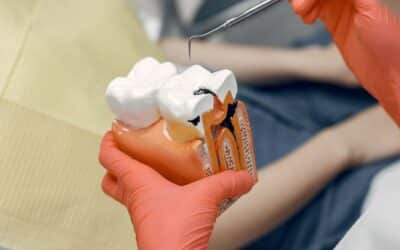 ¿Qué provoca las caries?