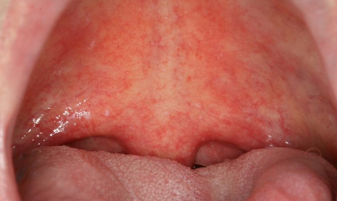 ¿Qué es la Candidiasis Oral?