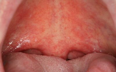 ¿Qué es la Candidiasis Oral?