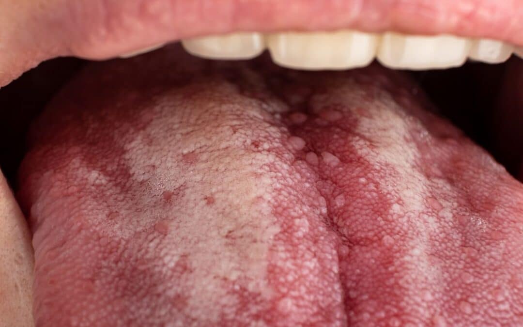 Candidiasis en la Lengua