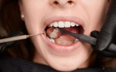 Conoce las causas del sarro dental