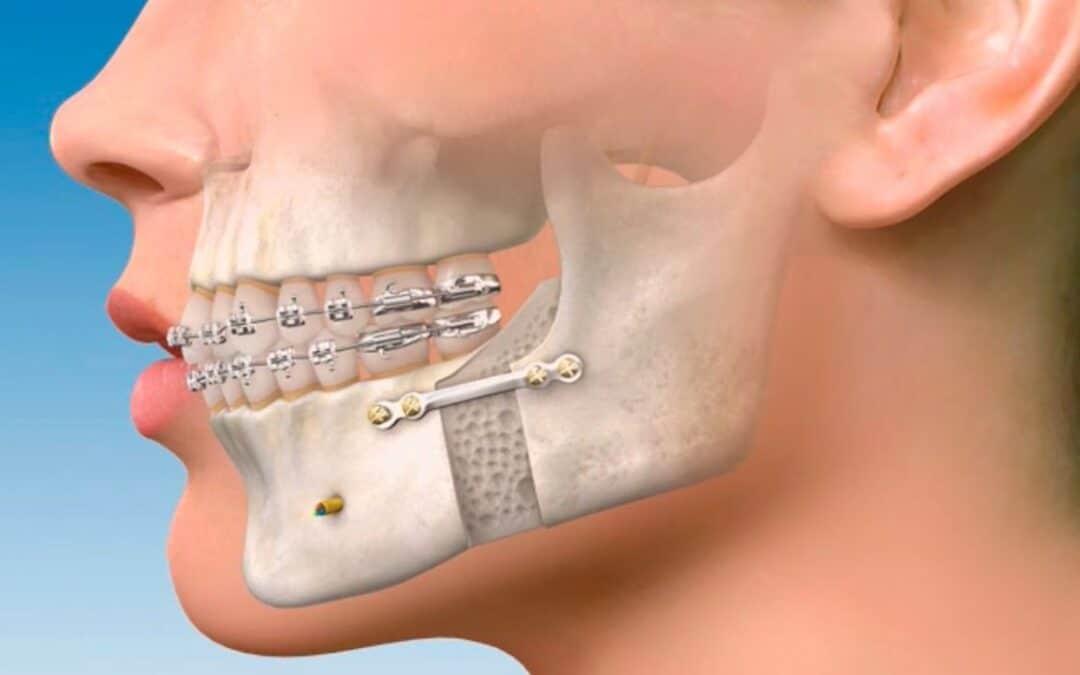 Cirugía ortognática: ¿Qué es y cuándo es necesaria?