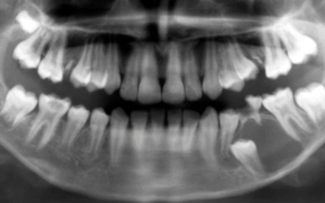 ¿Qué es un quiste dentígero y cómo se trata?