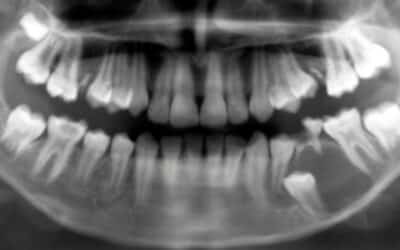 ¿Qué es un quiste dentígero y cómo se trata?