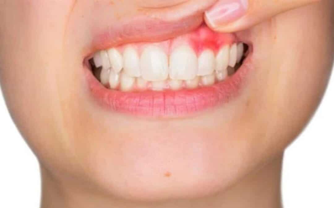 ¿Cómo saber si tengo un absceso dental?