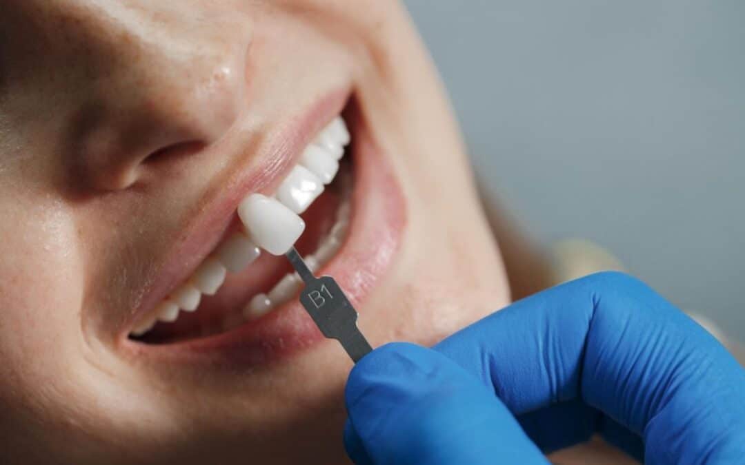 ¿Cuándo es recomendable utilizar implantes dentales?