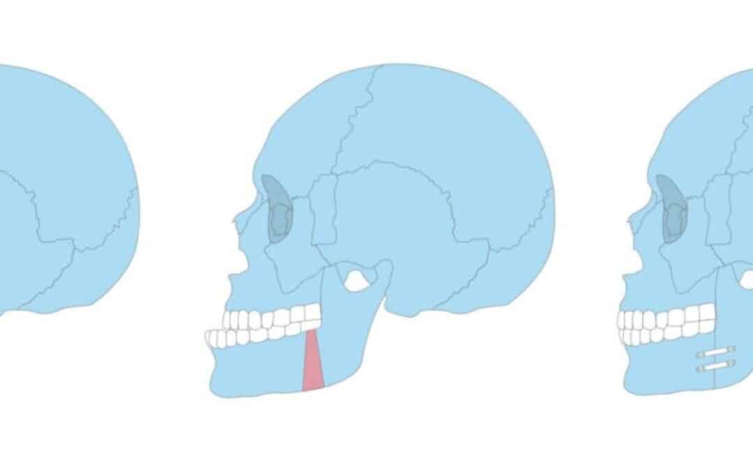 ¿Qué es una cirugía ortognática y quién la realiza?